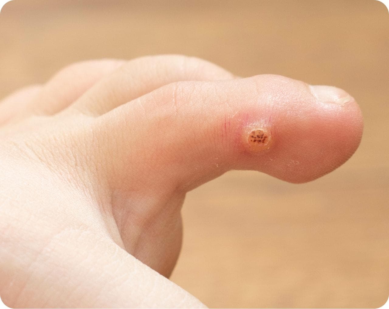 Wart Treatment