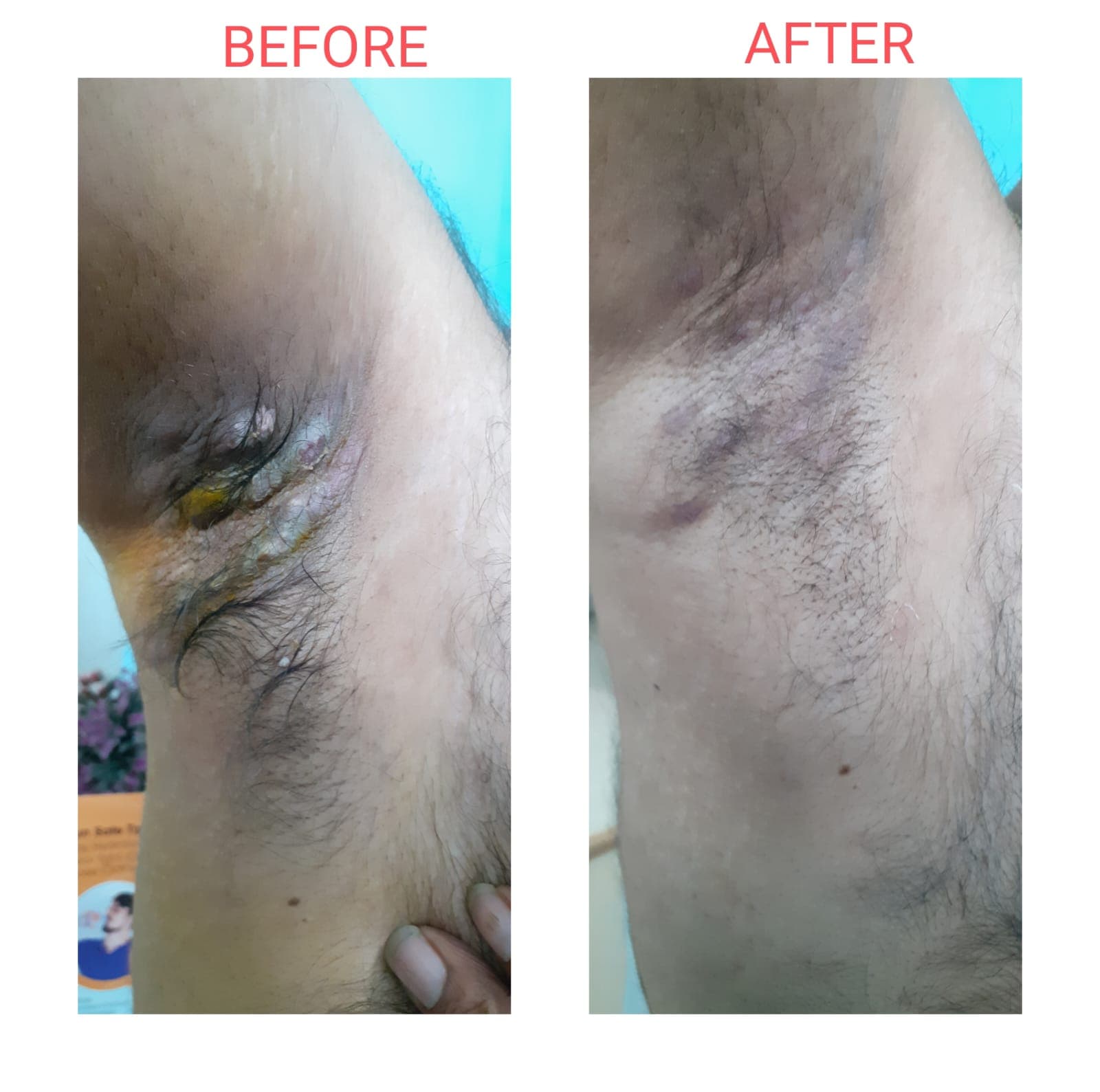 Hidradenitis Suppurativa before and after at Pranava Skin Clinic, Bangalore
