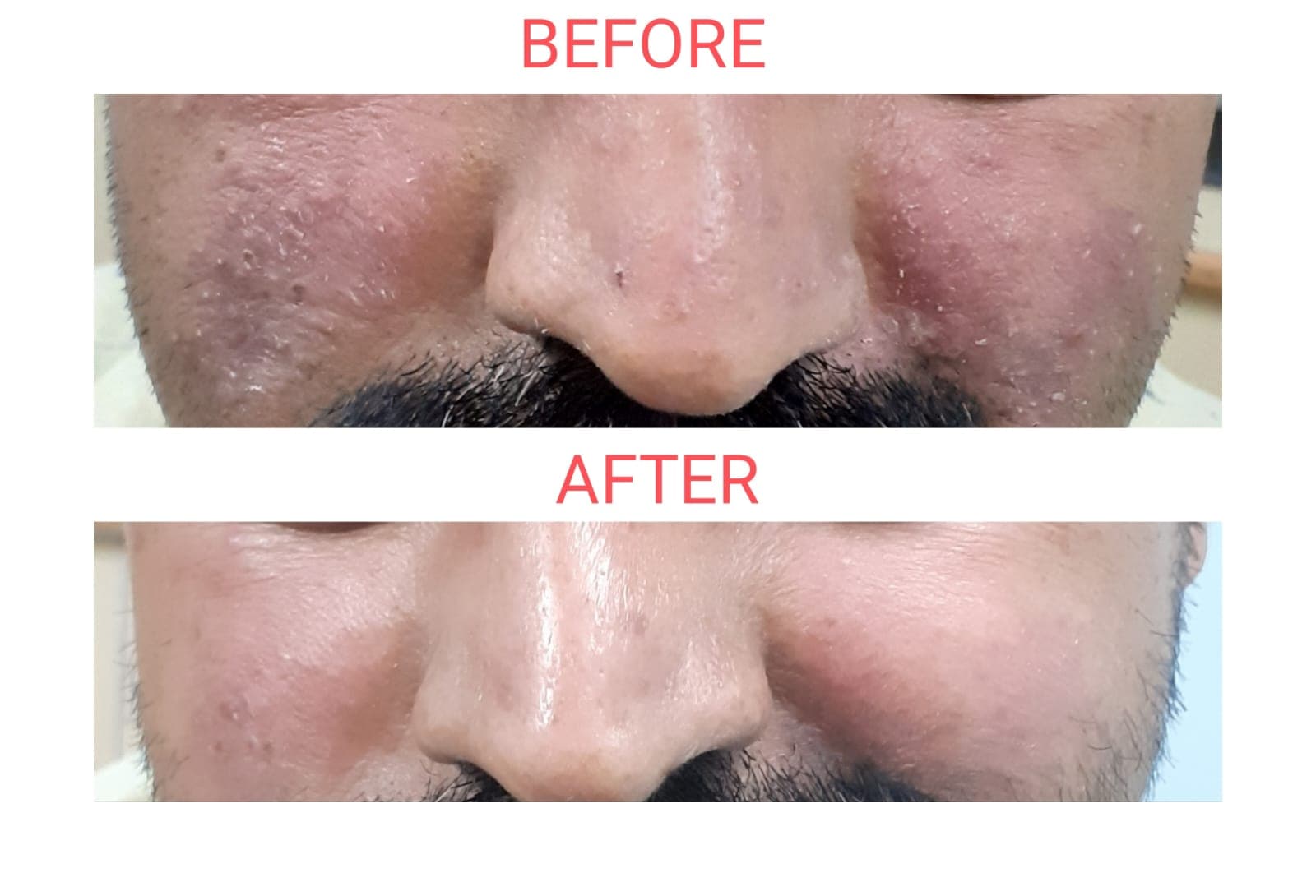 Acne & Skin Inflammation before and after at Pranava Skin Clinic, Bangalore