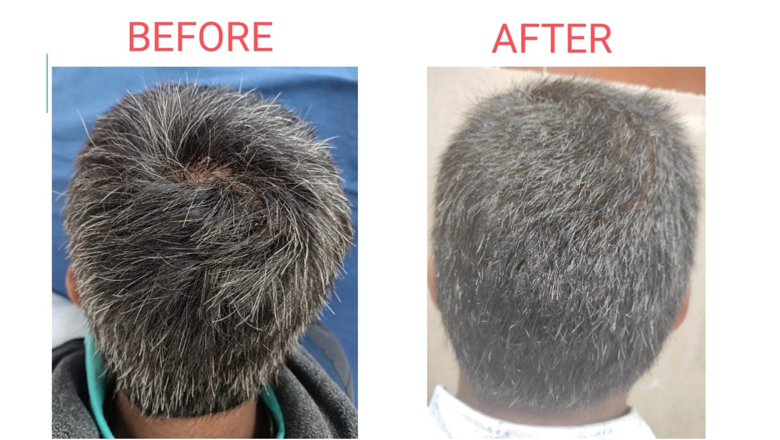 Premature Greying of Hair before and after at Pranava Skin Clinic, Bangalore