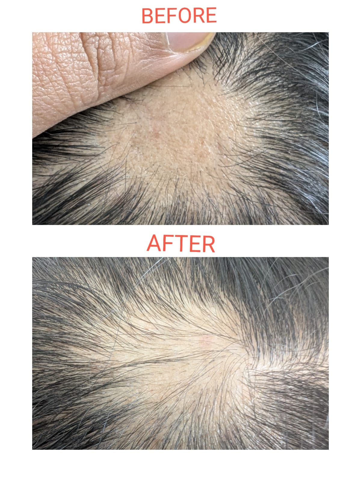 Hair Loss Treatment before and after at Pranava Skin Clinic, Bangalore