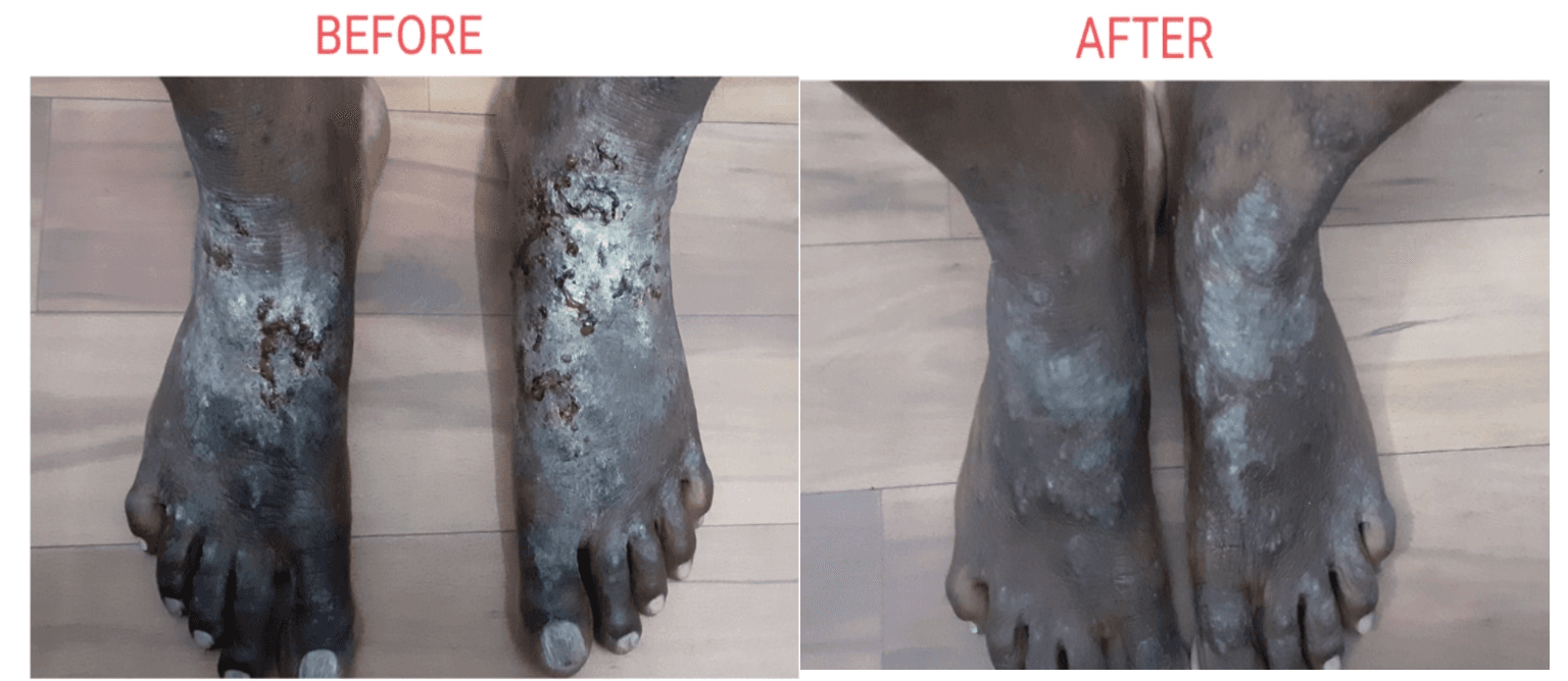 Eczema before and after at Pranava Skin Clinic, Bangalore